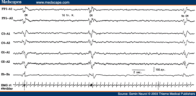 Figure 12. EEG of a 16-year-old patient with subacute sclerosing panencephalitis, showing high-amplitude generalized periodic complexes repeating at intervals of 8 to 10 seconds and accompanied by eye jerks and myoclonic jerks of the upper extremities monitored on the last two channels.