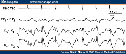 Figure 14. EEG of a 6-year-old patient with Batten's disease, showing high-amplitude spikes induced by photic stimulation at one per second.