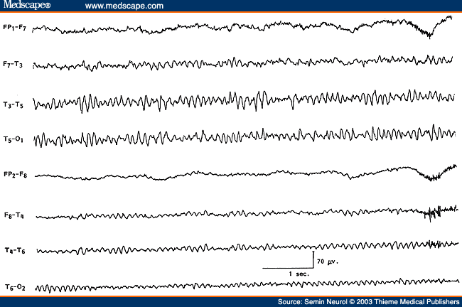 Figure 17. EEG of a 47-year-old patient with a low-grade glioma of the left temporal lobe, showing slightly slow but higher amplitude alpha on the left side.