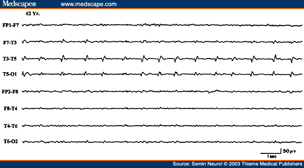 Figure 19. EEG of a 62-year-old patient with acute onset of right hemiparesis, aphasia, and right focal motor seizures, showing periodic lateralized epileptiform discharges over the right posterior temporal region.