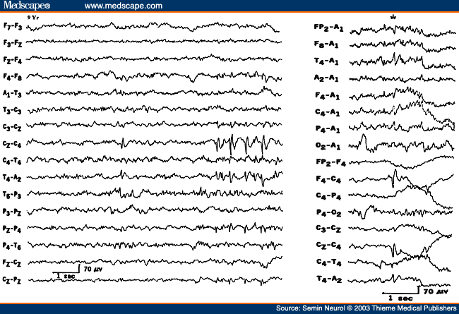 Figure 28. EEG of a 9-year-old child with benign Rolandic epilepsy, showing a focus of right centrotemporal spike discharges. The right half of the figure shows a spike discharge with horizontal dipole distribution.