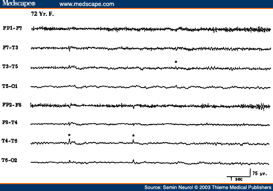 Figure 29. EEG of a 72-year-old patient, showing benign epileptiform transients of sleep (small sharp spikes).