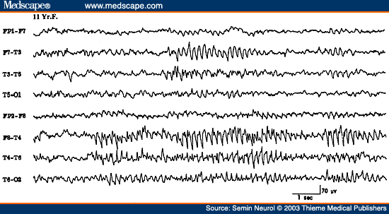 Figure 31. EEG of an 11-year-old patient, showing rhythmic midtemporal discharges during drowsiness.