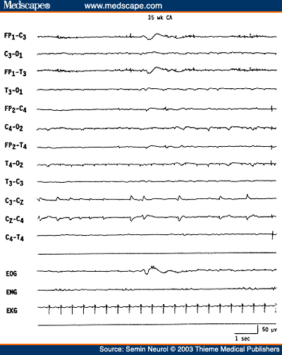 Figure 32. EEG of a neonate of 35 weeks conceptional age, showing low-amplitude positive Rolandic sharp wave discharges at the vertex (CZ) electrode. Patient had grade IV intraventricular hemorrhage and was unresponsive.