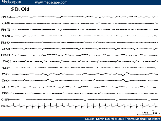 Figure 34. EEG of a 5-day-old neonate on ventilator, showing "depressed brain seizure" characterized by less than one per second, low-amplitude sharp waves over the right hemisphere.