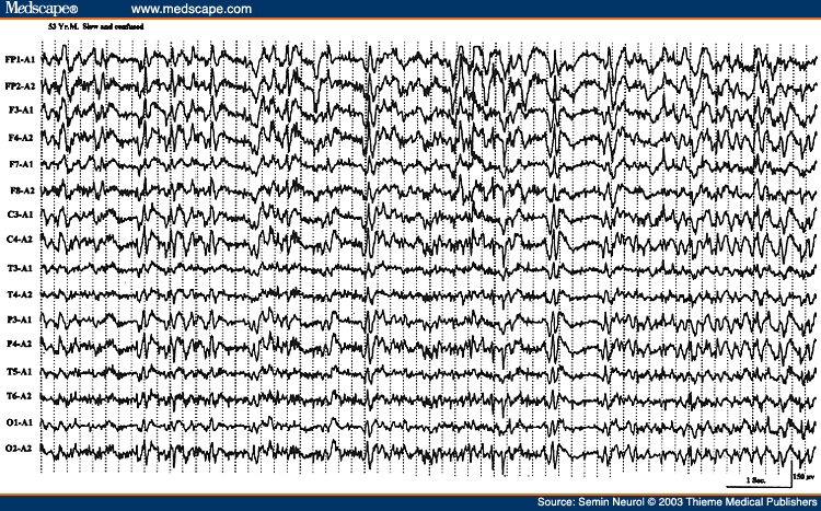 Figure 36. EEG of a 53-year-old man with one day history of acute confusion and slowness of motor responses, showing almost continuous generalized spike wave activity.