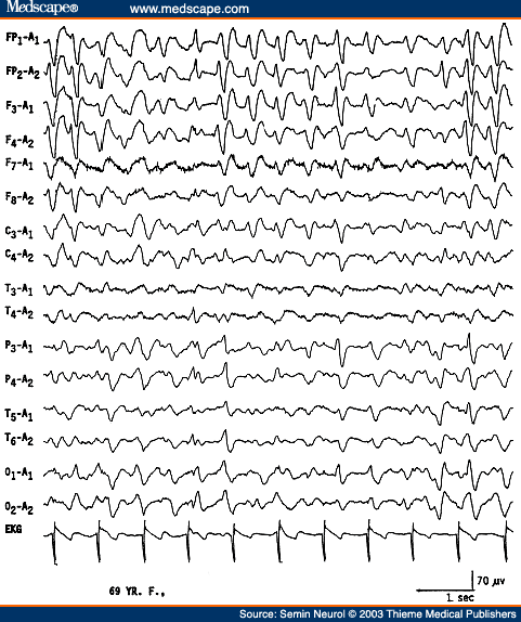 Figure 5. EEG of a 69-year-old patient with hepatic encephalopathy, showing triphasic waves. 