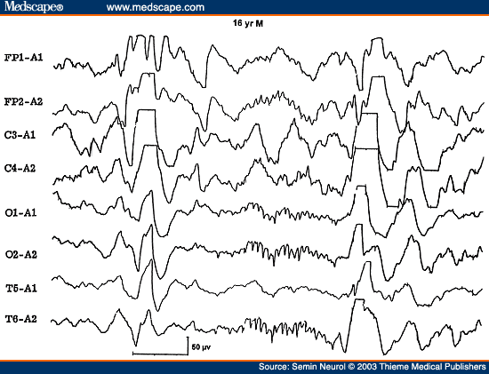 Figure 6. EEG of a 16-year-old comatose patient with Reye's syndrome, showing 14 cps positive spikes. 