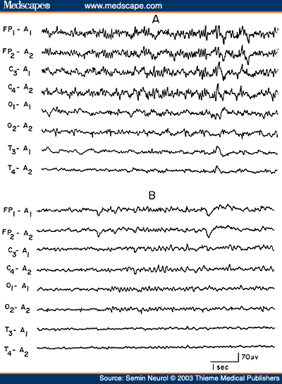 Figure 7. EEG of an 18-year-old patient with phenobarbital intoxication, showing generalized theta-delta activity with superimposed beta frequencies (A) followed in 3 days by normalization of the EEG (B).