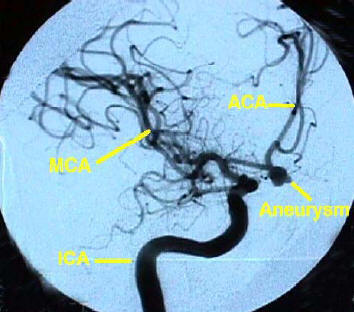 Look at CT head and Angiogram findings