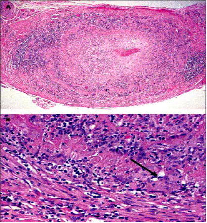 Look at Biopsy findings (Fig 4)