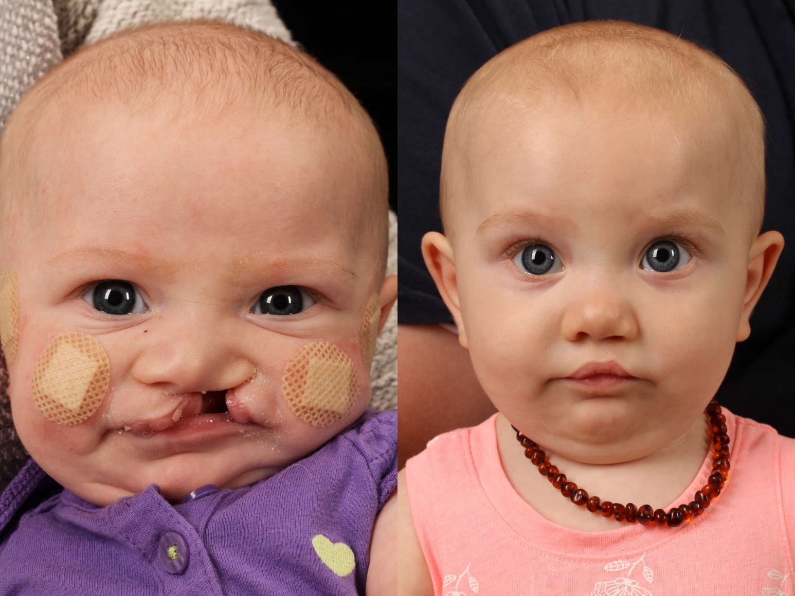 Cleft Lip and Cleft Palate